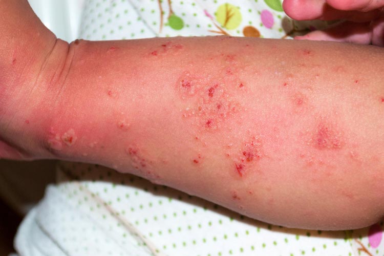 Skin Rash: 9 Questions That Will Help You Decode That Skin Rash