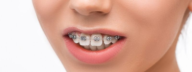 How to Fix Overbite? 5 Effective Solutions