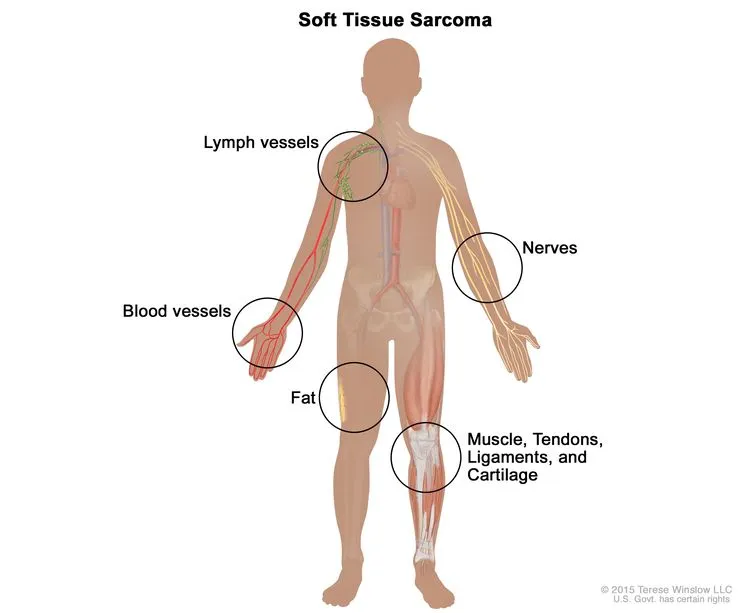 Sarcoma cancer: causes, symptoms, and treatments