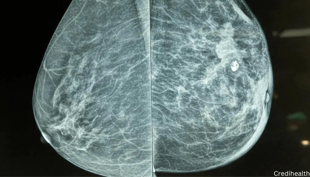 What Should I Know About Mammogram Screen...