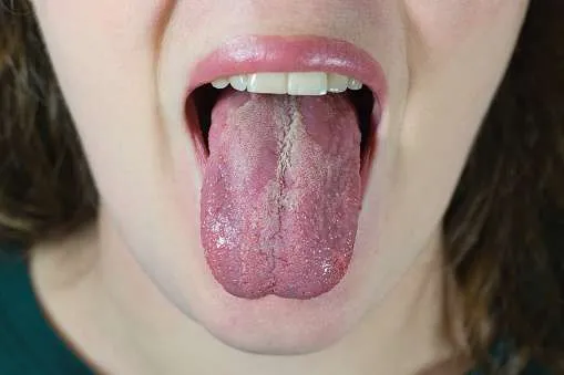 Candida mouth infection