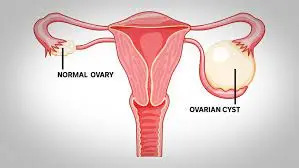 ovarian cyst in hindi, what is ovarian cyst in hindi