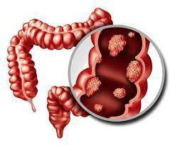 Colon Cancer: Symptoms, Causes, Risk Factors, Diagnosis &...