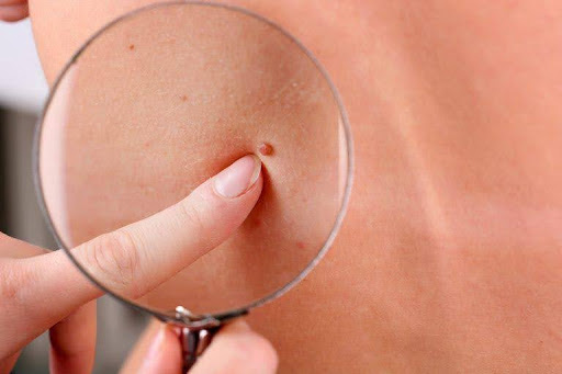 Types of Skin tag and How to remove Them